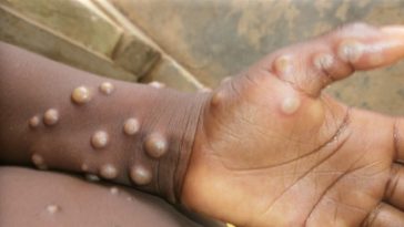 Mpox: Africa reports 14,669 cases, 55 deaths in 2024 – WHO Director 