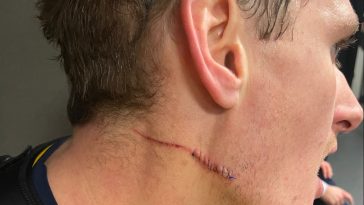 The huge cut on Michael McCarron’s face