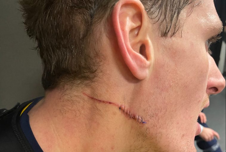 The huge cut on Michael McCarron’s face
