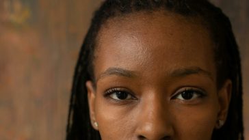 Titilade Ilesanmi: How My Face Acne Affected My Self Esteem 