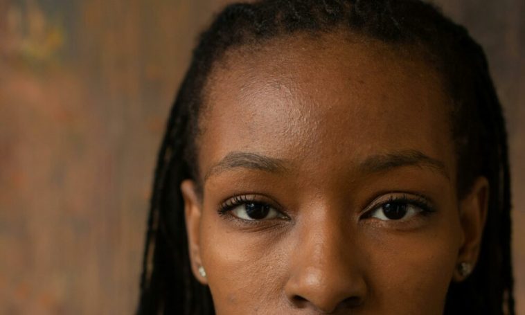 Titilade Ilesanmi: How My Face Acne Affected My Self Esteem