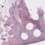 The Download: AI for cancer diagnosis, and HIV prevention