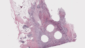 The Download: AI for cancer diagnosis, and HIV prevention