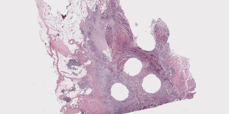 The Download: AI for cancer diagnosis, and HIV prevention