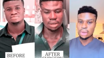 Zicsaloma Does a Full Recap and Real Reason Why He Did a Nose Surgery