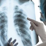Casos de tuberculosis en México: ¿Cuáles son los síntomas?