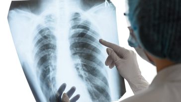 Casos de tuberculosis en México: ¿Cuáles son los síntomas?