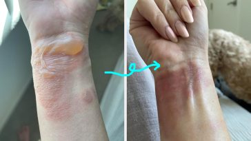 17 Personal Care Products With Before And After Photos So Gnarly, You Probably Shouldn’t Look If You’re Squeamish
