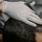 The Secret to Affordable Celebrity Hair: How Much Is a Top-End Hair Transplant in Turkey?