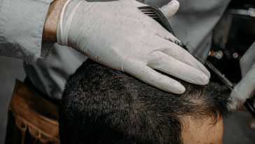 The Secret to Affordable Celebrity Hair: How Much Is a Top-End Hair Transplant in Turkey?