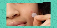 These 5 Pimple Patches are Nigerian Favourites for Their Price and Effectiveness