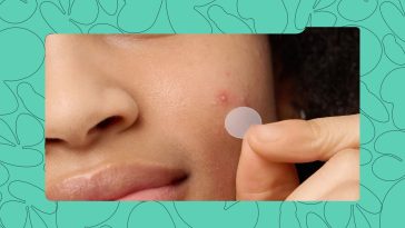 These 5 Pimple Patches are Nigerian Favourites for Their Price and Effectiveness