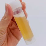 If Your Urine Always Foams, Here Are 5 Possible Causes