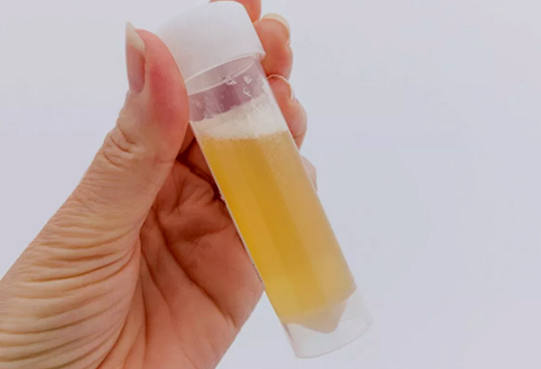 If Your Urine Always Foams, Here Are 5 Possible Causes