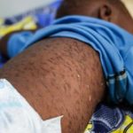 Measles outbreak threatens public health in Cuanza Sul