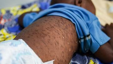 Measles outbreak threatens public health in Cuanza Sul