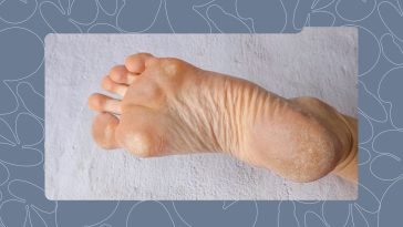 Safe and Effective Ways to Remove Callus From Your Feet