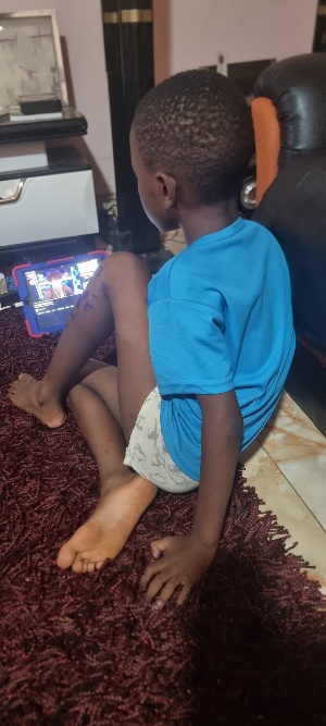 “Early care saved my son from severe mpox disease”