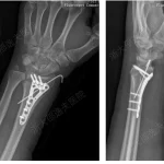 Inspired by Oysters! China’s “Bone 02” Solves Comminuted Fractures — Bonds in 3 Minutes, Avoids Secondary Surgery