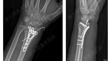 Inspired by Oysters! China’s “Bone 02” Solves Comminuted Fractures — Bonds in 3 Minutes, Avoids Secondary Surgery
