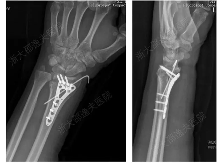 Inspired by Oysters! China’s “Bone 02” Solves Comminuted Fractures — Bonds in 3 Minutes, Avoids Secondary Surgery