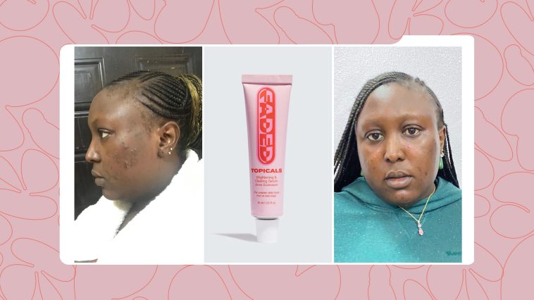 Why I’m Adding Topicals Faded to My Skincare Routine After A Month