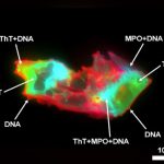 People With Long Covid Have This Freaky-Looking Thing in Their Blood
