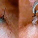 How to Get Rid of Ingrown Hair: Simple, Safe, and Effective Tips That Work